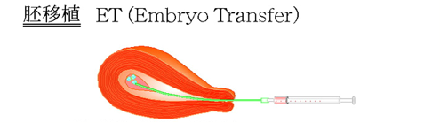 ڐA@Embryo Transfer